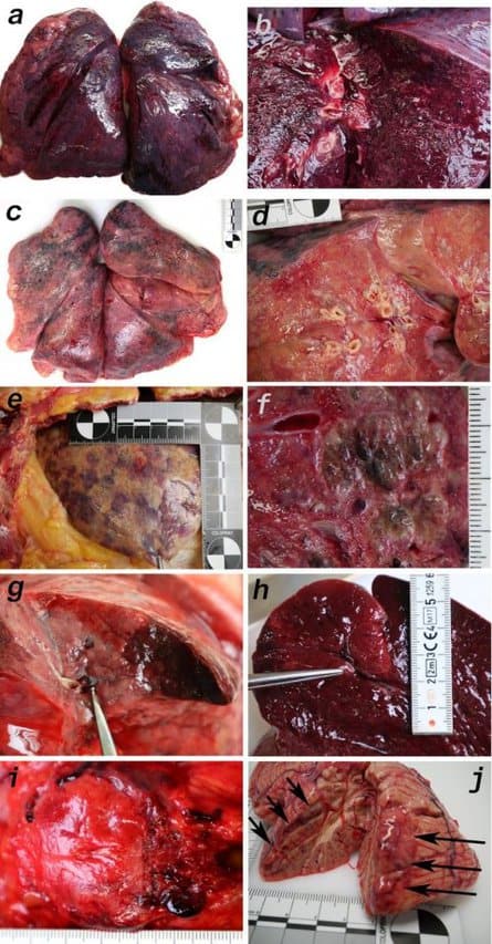  Covid-19 mapping reveals organ distribution and tissue damage