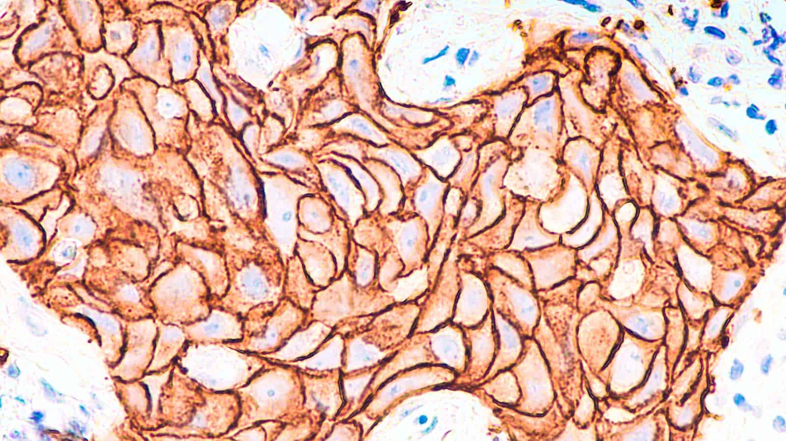 Digital Pathology Her2 Breast Cancer