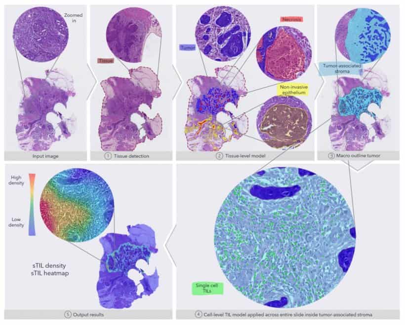 AI in triple negative breast cancer