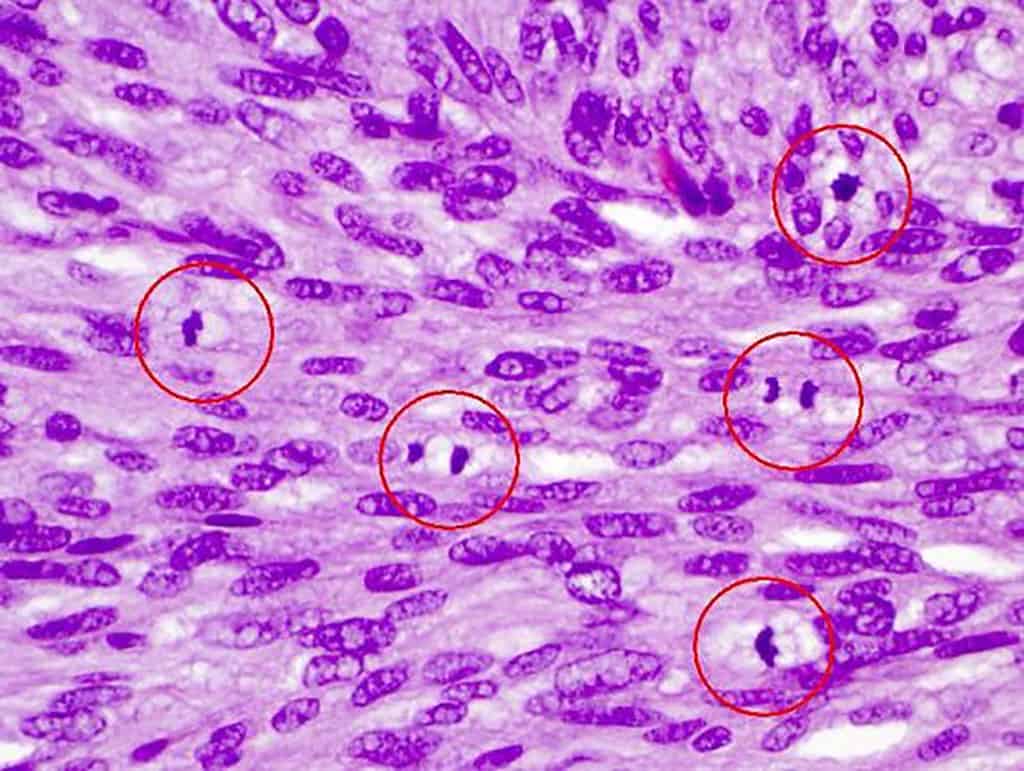 Counting mitoses - Digital Pathology
