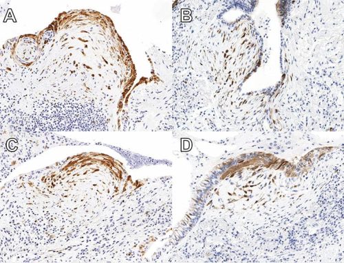Digital Spatial Profiling Augments Pathology in Diagnosing Pulmonary Fibrosis