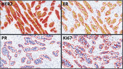 Breast-IHC-AI