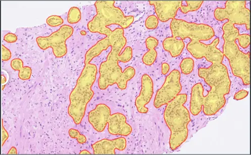 HALO-Prostate-AI