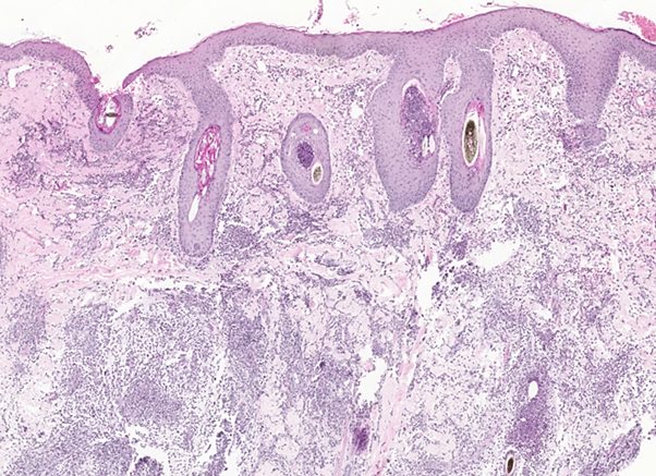 Eosinophilic dermatitis, folliculitis and furunculosis