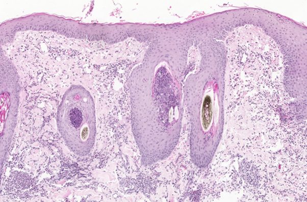Eosinophilic dermatitis, folliculitis and furunculosis