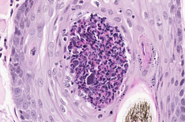Significant intraluminal follicular inflammation composed mainly of eosinophils