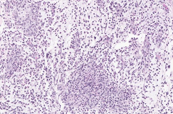 Eosinophilic dermatitis and furunculosis