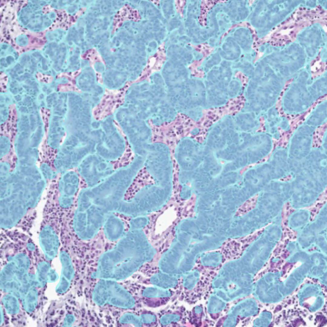 Aiforia Gastric Cancer AI model