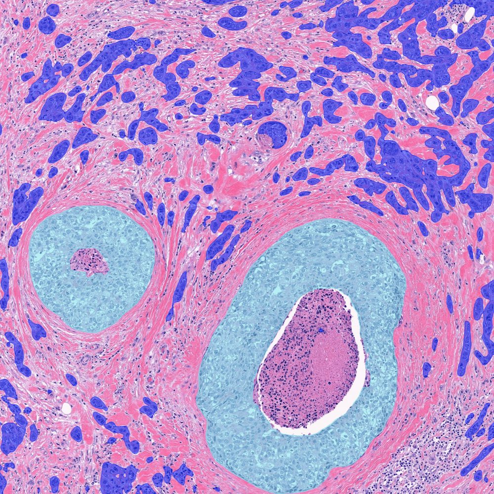 Aiforia Breast Cancer Grading