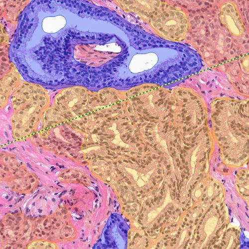 Aiforia Prostate Cancer Biospsy