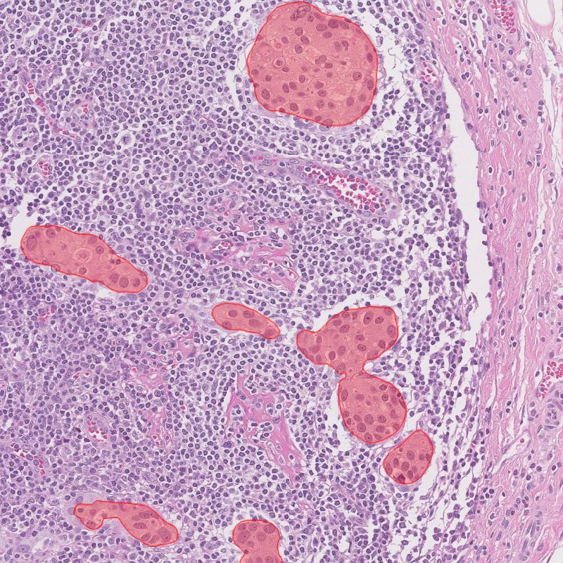 Aiforia lymph node metastasis pathology news