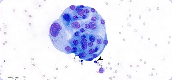 Figure 1. Abdominal mass. Photomicrograph presenting clusters of markedly pleomorphic epithelial cells. The size of the cells can be compared to a neutrophil (arrowhead). Leishman stain, x50 objective.