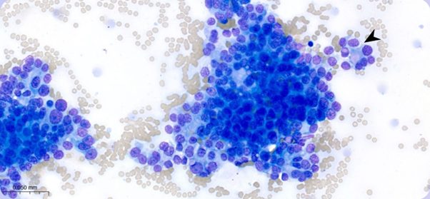Figure 2. Abdominal mass. Photomicrograph presenting a larger cluster of relatively uniform epithelial cells showing vague acinar type arrangements, suggesting secretory origin (arrowhead). Leishman stain, x50 objective.