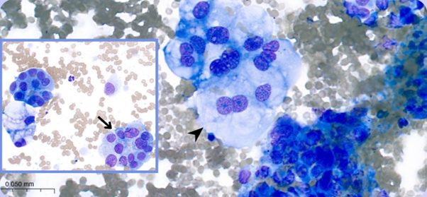 Figure 3. Abdominal mass. Photomicrographs presenting clusters of markedly pleomorphic epithelial cells. Binucleation (arrowhead) and vague acinar structures (arrow) are noted. Leishman stain, x50 objective.