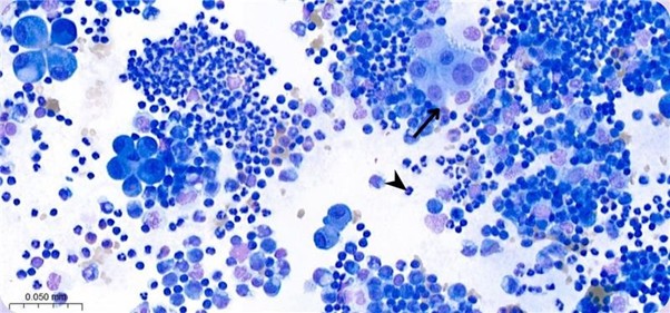 Figure 4. Peripheral effect. Photomicrograph of neoplastic, inflammatory effect presenting clusters of pleomorphic cells (arrow). The size of the cells can be compared to a neutrophil (arrowhead). Leishman stain, x50 objective.
