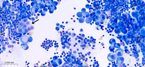 Figure 5. Peripheral effusion. Similar to Figure 4, with one group of cells resembling epithelial appearance (arrow). Leishman stain, x50 objective.