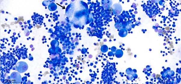 Figure 6. Peripheral effusion. Photomicrograph of a large pleomorphic cluster of cells (arrow). Leishman stain, x50 objective.