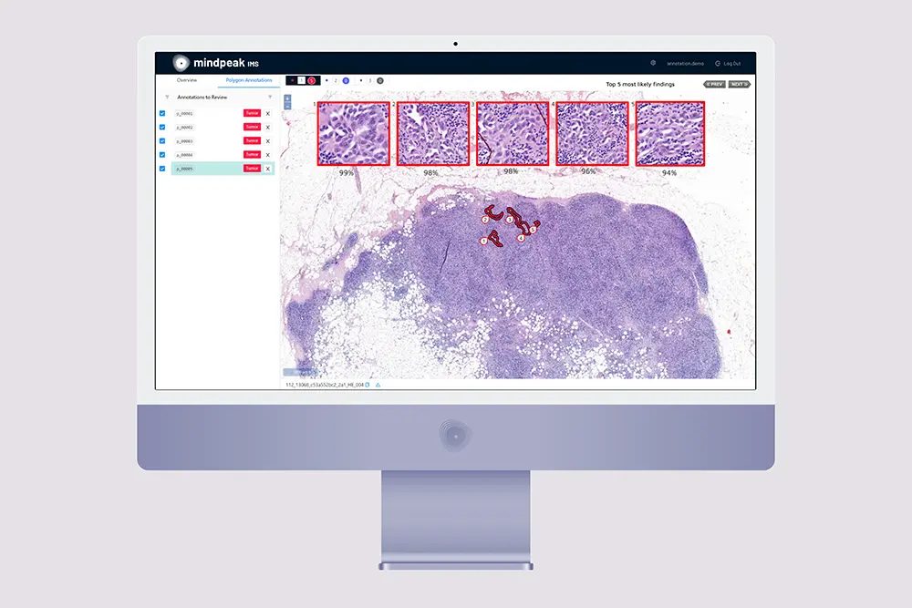 01 mindpeak screen breast metastasis detector 1000px