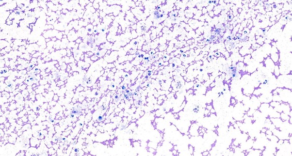 Figure 1: Photomicrograph of direct smears from a fine-needle aspirate of a mass in a cat, stained with Leishman stain. Low numbers of poorly preserved neutrophils and a few vacuolated macrophages within a dense eosinophilic proteinaceous background, x40 objective.