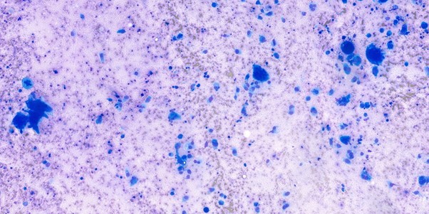 Figure 2: Several atypical spindle-shaped cells arranged individually and in loose aggregates, with frequent binucleation and multinucleation observed, x20 objective.