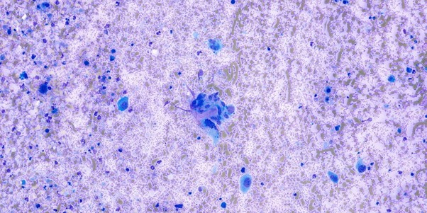 Figure 3: A cluster of atypical spindle-shaped cells associated with pink extracellular material, x40 objective.