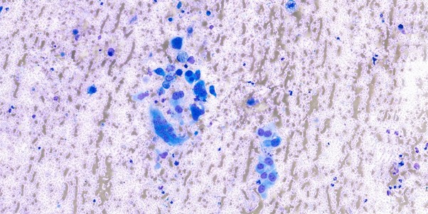Figure 4: Atypical spindle-shaped cells, with binucleated and multinucleated cells present. These cells have oval nuclei with finely stippled chromatin and one to multiple prominent round nucleoli, x40 objective.