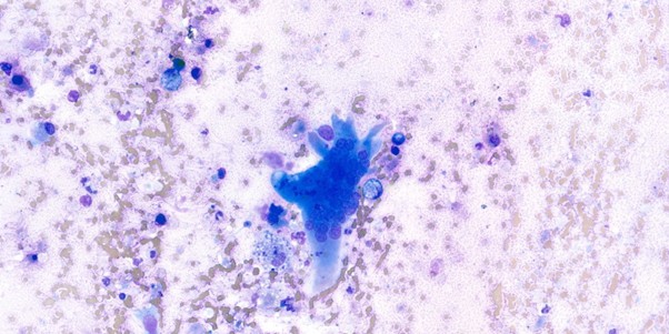 Figure 5: Presence of a giant multinucleated cell, x60 objective. Interpretation