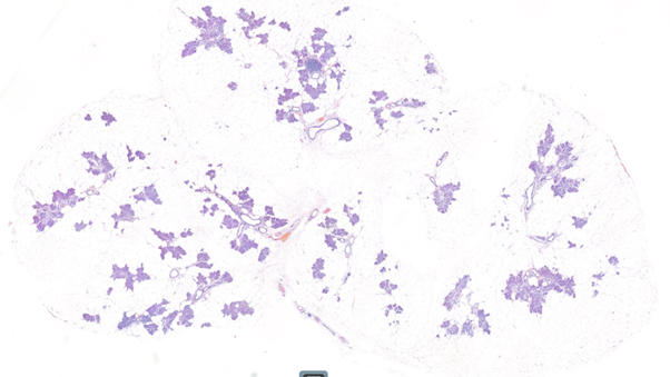 Salivary gland. Non-capsulated proliferation of mature adipocytes that are arranged in lobules and are interspersed with salivary acini and ducts