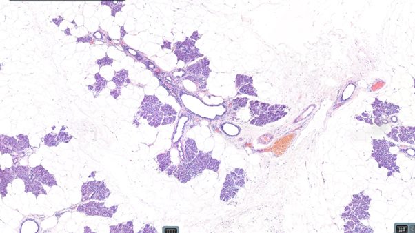 Salivary gland. Mature adipose tissue interspersed with normal salivary gland cells