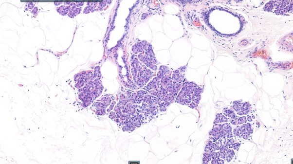Salivary gland. Mature adipose tissue interspersed with normal salivary gland cells