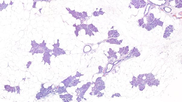 Salivary gland. Mature adipose tissue interspersed with normal salivary gland cells