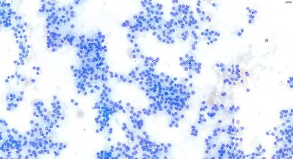 Figure 1: The smears revealed some blood with aggregates of polygonal or slightly spindloid cells forming vague chains and rosettes