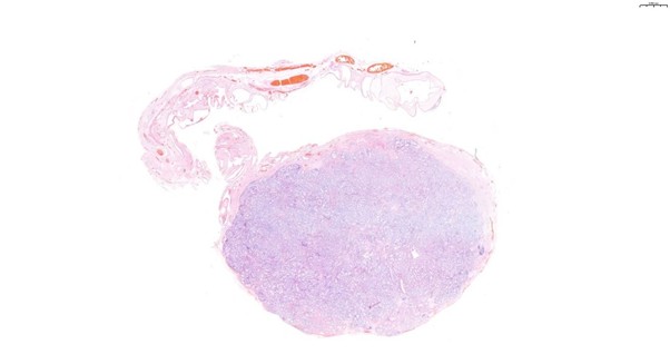 Figure 2: Histological evaluation revealed a discrete but nonencapsulated ovoid nodular mass