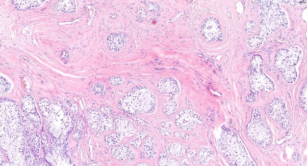 Figure 3: The findings closely resembled normal Sertoli cells