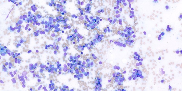 Figure 1: Photomicrograph of direct smears from a fine-needle aspirate of a golf ball-sized mass on the neck of a dog, stained with Leishman stain. The smear shows several intermediate to large lymphocytes with scant to moderate amounts of pale blue cytoplasm, frequently containing multiple magenta granules. Scattered among them are low numbers of small lymphocytes, x60 objective.