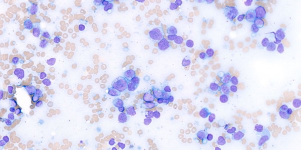 Figure 2: Several intermediate to large lymphocytes with pale blue cytoplasm, containing multiple magenta granules. The nuclei are round to angular, with finely stippled chromatin, and one to two nucleoli are visible in some cells. Leishman stain, x100 objective.