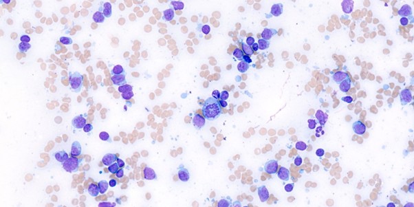 Figure 3: Occasional mitotic figures present. Leishman stain, x100 objective.