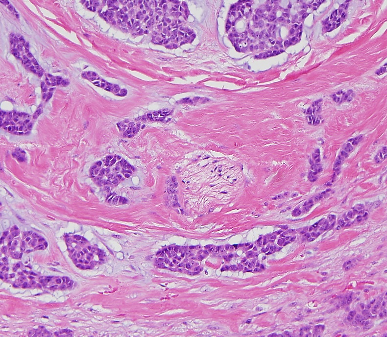 Perineural invasion Techcyte Digital Pathology