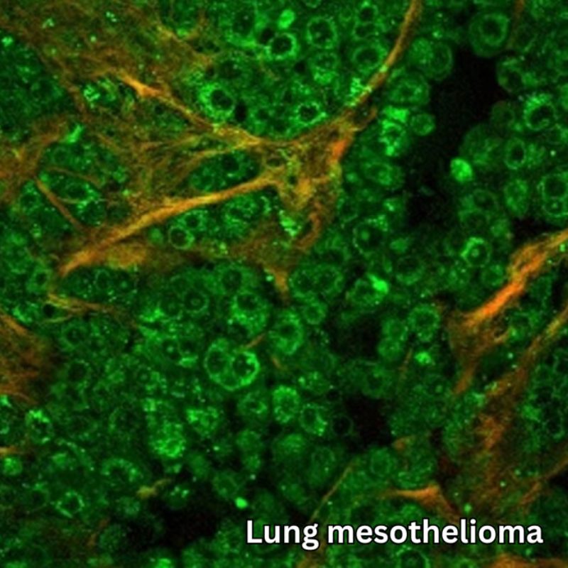 Lung Mesothelioma