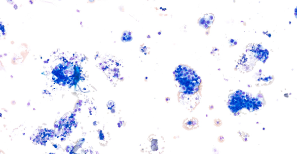 Nation WideLab Prostatic Abnormality