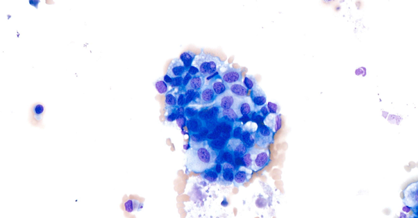 Nation WideLab Prostatic Abnormality