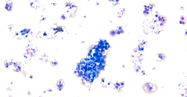 Nation WideLab Prostatic Abnormality