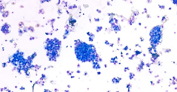 Nation WideLab Prostatic Abnormality