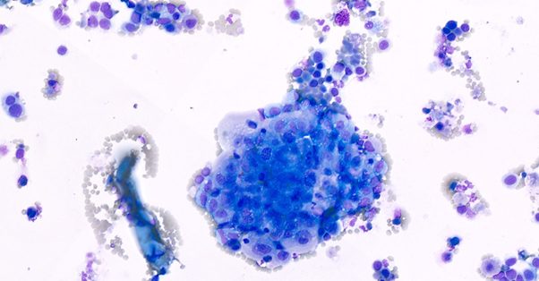 Nation WideLab Prostatic Abnormality