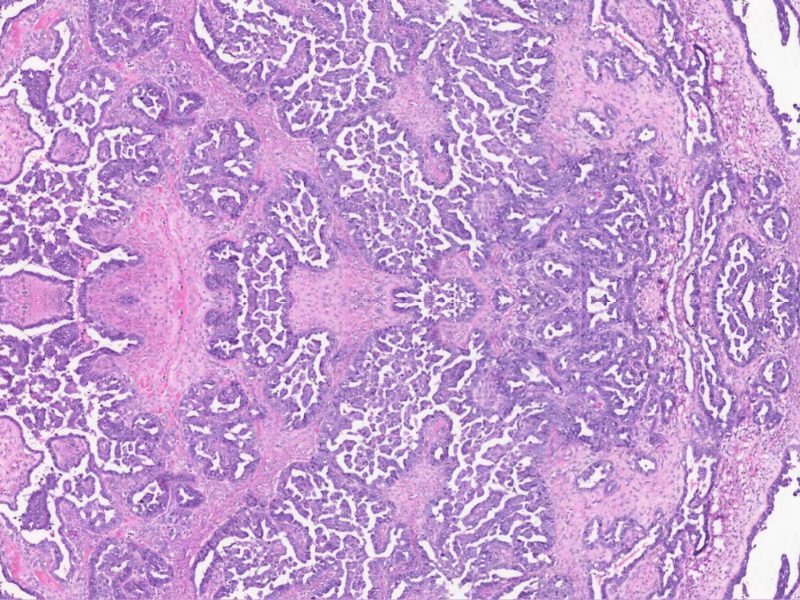 Can AI Predict Patient Outcomes in Ovarian Cancer? Aiforia