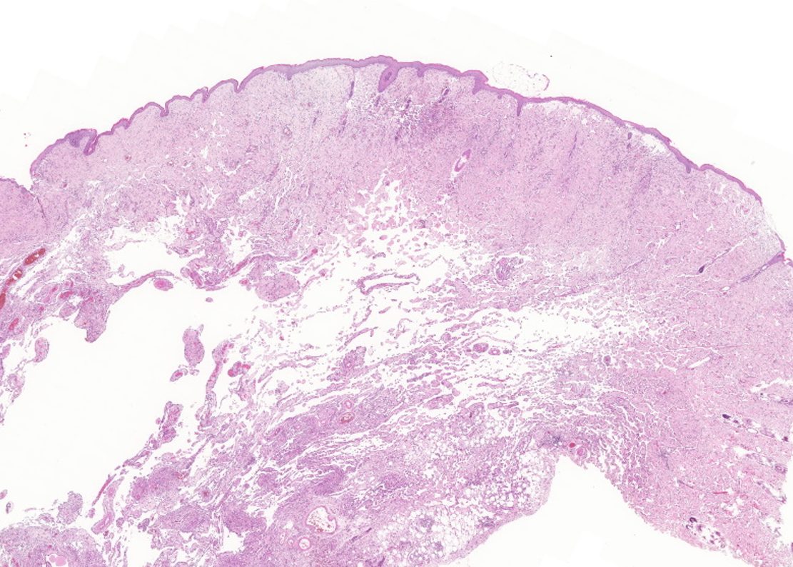 Lymphangiosarcoma in a cat