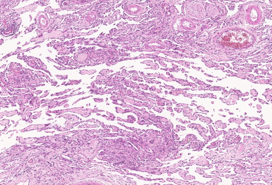Lymphangiosarcoma in a cat