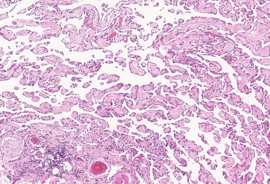 Lymphangiosarcoma in a cat