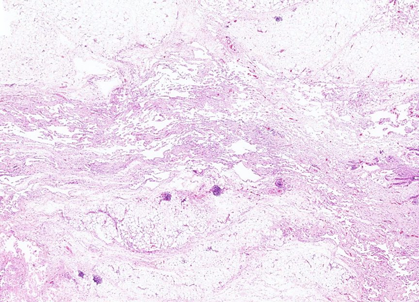 Lymphangiosarcoma in a cat