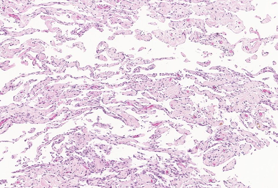 Lymphangiosarcoma in a cat